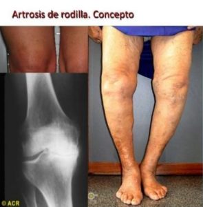 http://proloterapiard.com/wp-content/uploads/2017/09/artrosis-de-rodilla-pedraza-17-638-1-295x300.jpg