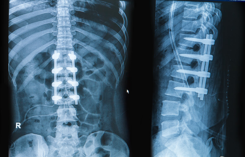 Cirugía de columna lumbar - Serie—Anatomía normal: MedlinePlus enciclopedia  médica
