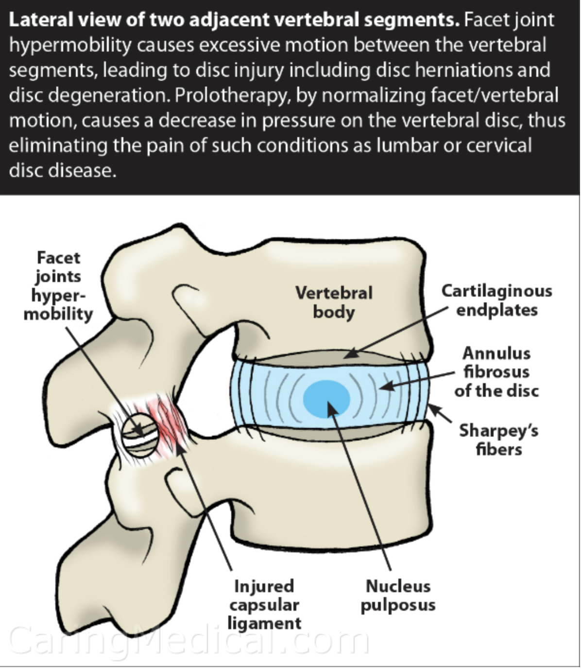 Tratamiento de la espondilosis lumbar ¿Funcionan las inyecciones