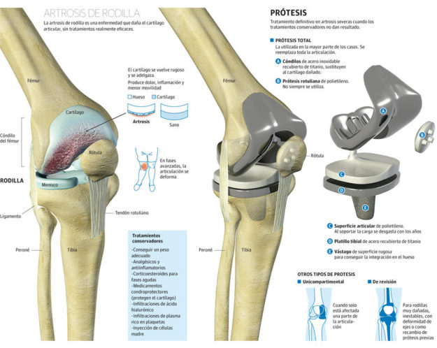 protesis de rodilla