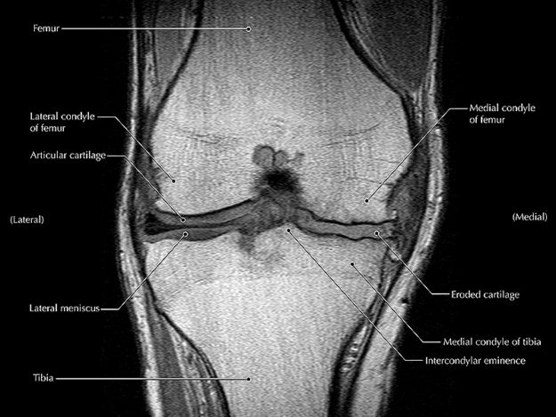 knee-mri-stemcell-institute