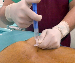 Inyección-Epidural-Translaminar